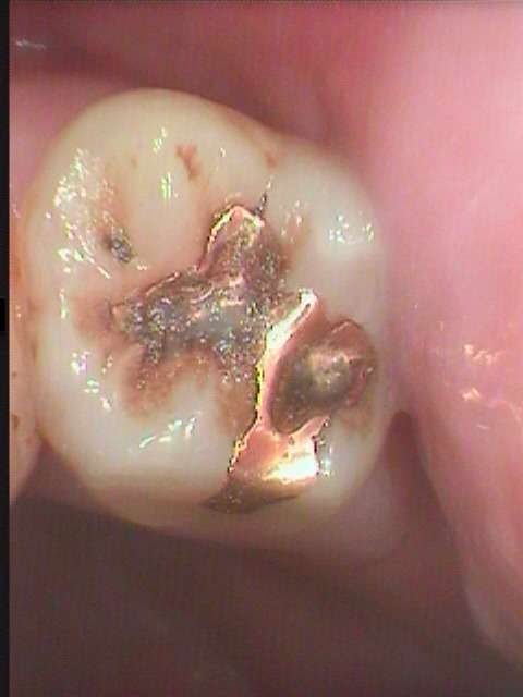 虫歯治療の基本的な症例です。最新の虫歯治療は詰め物が歯に接着して一体化し、その色も歯と同じ審美治療です。