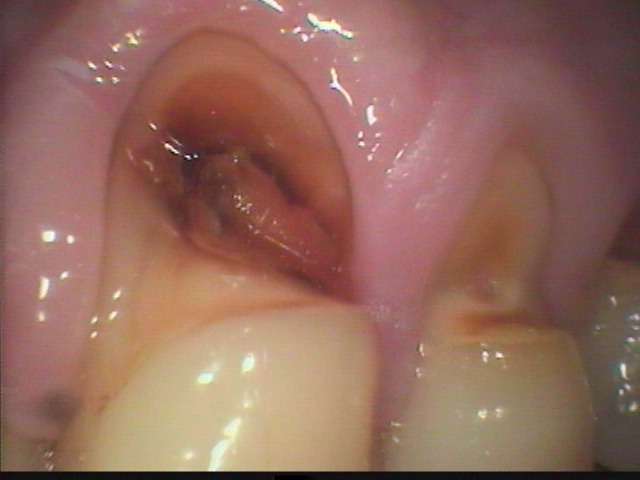 歯ぐきに近い所の虫歯治療です。歯に詰め物が接着し、しかも歯と同じ色のものになる接着性審美治療の症例です。