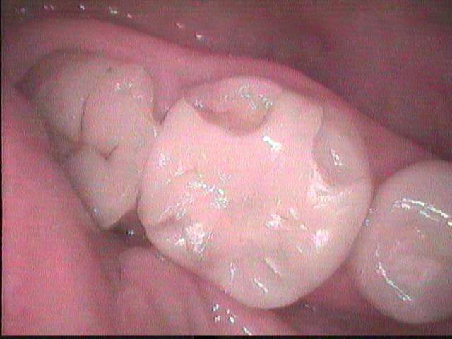 虫歯治療はその場で詰める接着性充填法が一番長持ちします。
