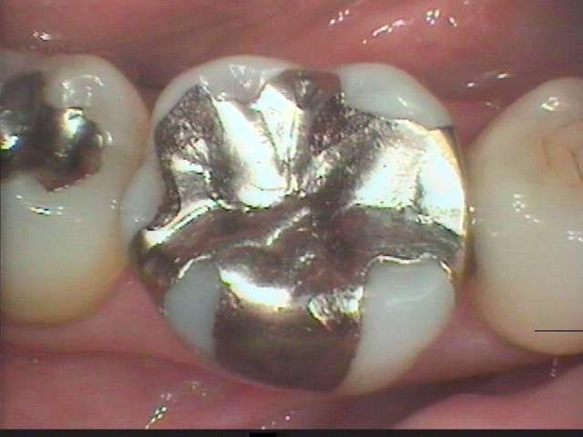 今日は、成城学園前駅　徒歩０分の鈴木歯科医院です。虫歯治療の時に金属充填をするのは危険です。