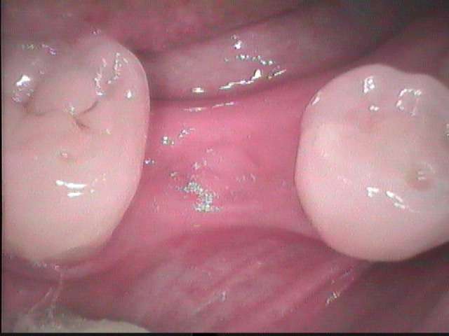 インプラントを小臼歯に入れた症例です。インプラントの埋入オペは殆ど痛みません。