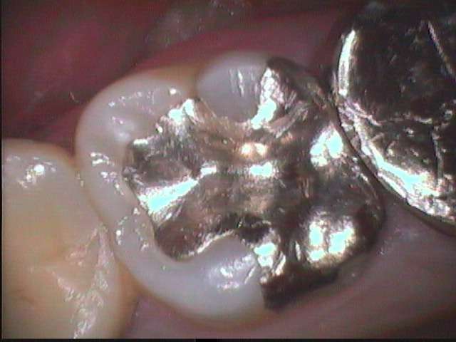 数多くの虫歯の再治療をしていますが、経験上、金属を詰める方法は虫歯再発が多くみられますので、これは避けたほうが賢明です。