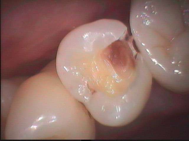 根管治療をする予定ではなかったのですが、虫歯の再発が深く大きくかったので止むを得ず根管治療をしました。