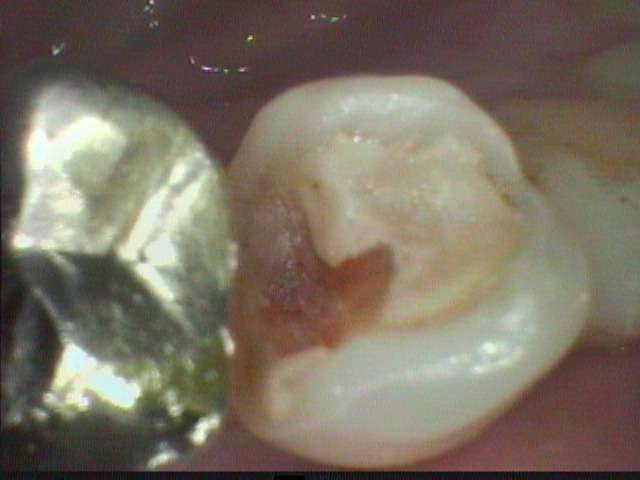 かなり広範囲に進んいる虫歯も歯と同じ色の接着性・審美治療で治しました。