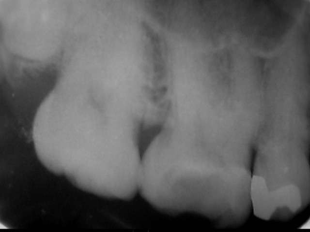 虫歯が進みすぎ、感染が深部に及んだので根管治療をしました。そのレントゲン写真です。