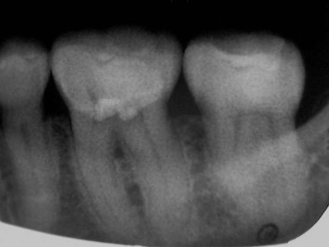 虫歯が歯の深部まで進行していたので根管治療をしました。その術前・術後のレントゲン写真です。
