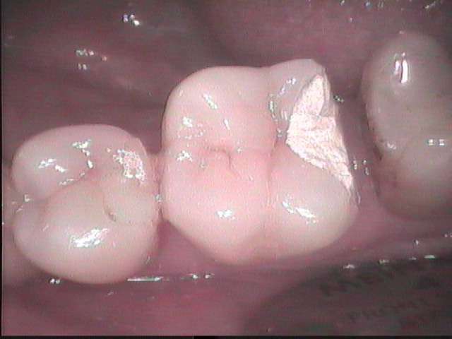 大臼歯の一部分が虫歯になったので審美的に綺麗に治しました。