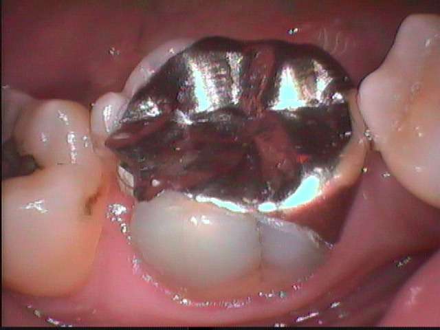 虫歯が再発して金属充填の下に広がっていました。