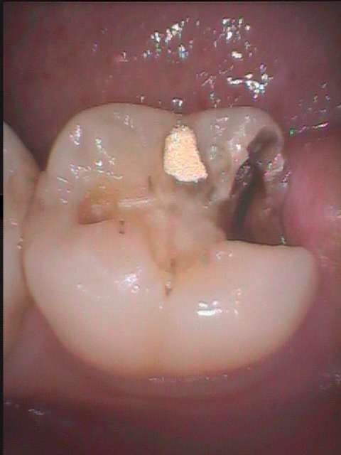 大きく虫歯が拡がっていたので、虫歯の再発が少ない治療をしました。原則として、虫歯の治療は１回の通院で治ります。