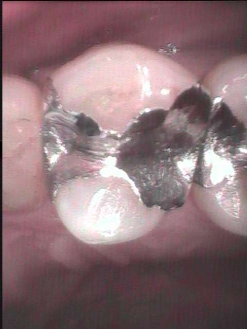 虫歯が再発した小臼歯の再治療です。金属の詰め物を外して、虫歯再発が少ない治療をしました。