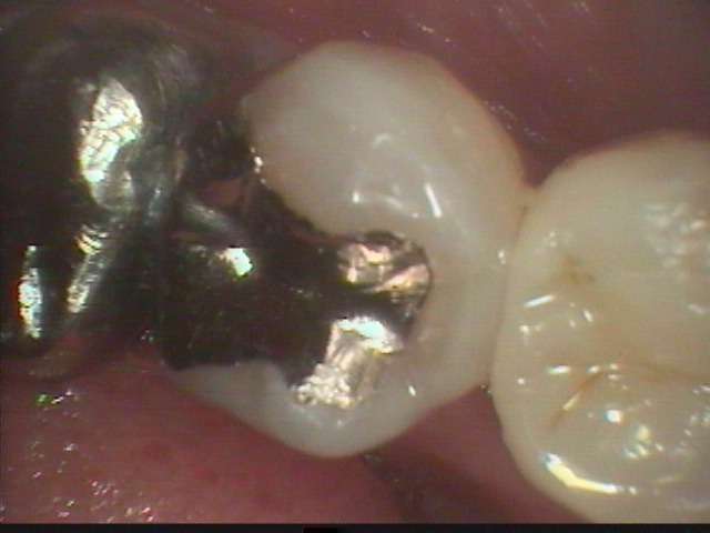 下顎小臼歯の虫歯を治しました。歯と同じ形と色で治す接着性の審美治療です。