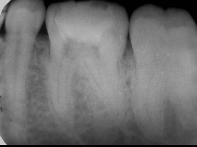 細菌感染した下顎大臼歯を根管治療しました。今回はそのレントゲン写真です。