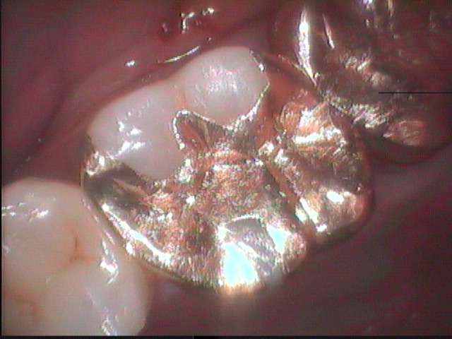 上顎大臼歯の虫歯治療です。現在の最先端の虫歯治療は金属を詰めません。金属充填の下に虫歯が再発するからです。