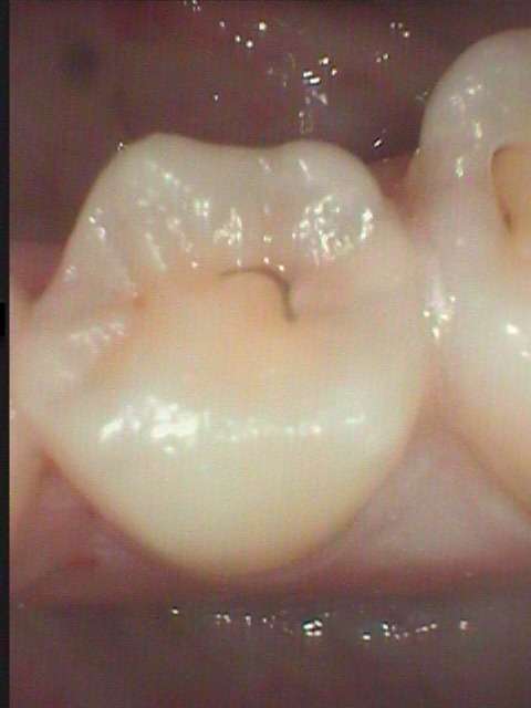 小臼歯に小さな虫歯が出来ました。