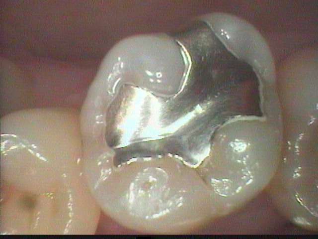 金属インレーの下に虫歯が再発しました。