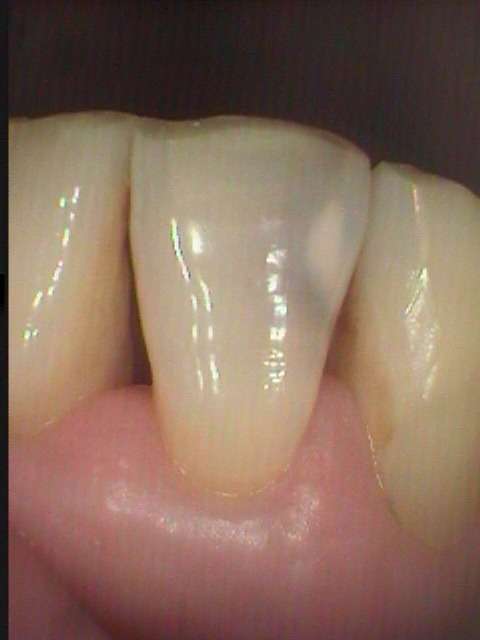 下顎の前歯に虫歯が出来たので、審美治療で綺麗に治りました。
