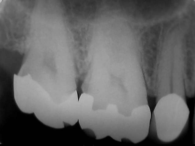 虫歯が進んで歯髄（神経）が細菌感染したので、この根管治療をしました。