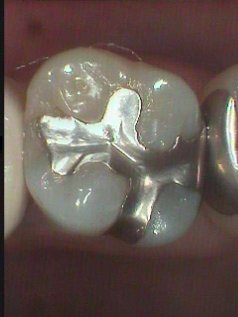金属充填された歯は、往々にして虫歯の再発が見られます。