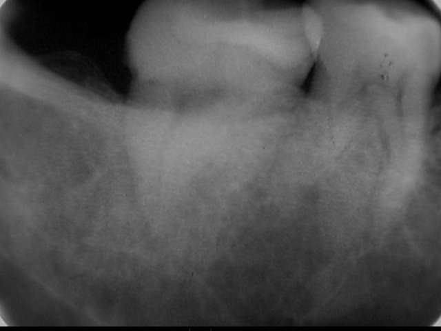 根管治療の術前・術後のレントゲン写真です。虫歯治療した所が、歯冠清掃が不足していたために虫歯が再発し、歯髄炎を起こして激痛が続きました。この治療の症例です。