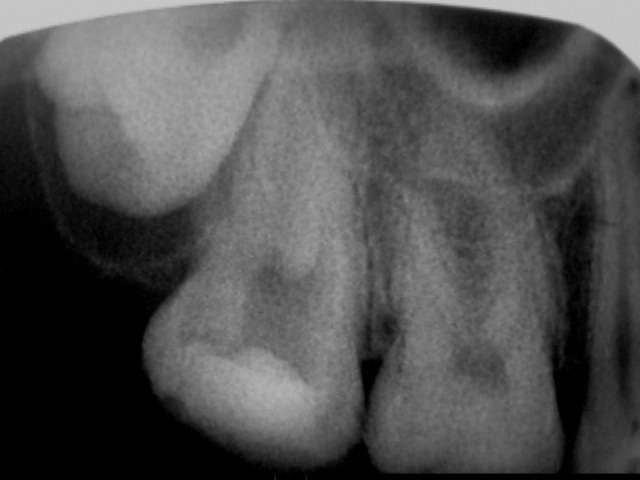 感染根管治療をしました。虫歯が歯の中に深く進んで歯髄（神経）まで細菌感染してかなりの痛みがあったからです。