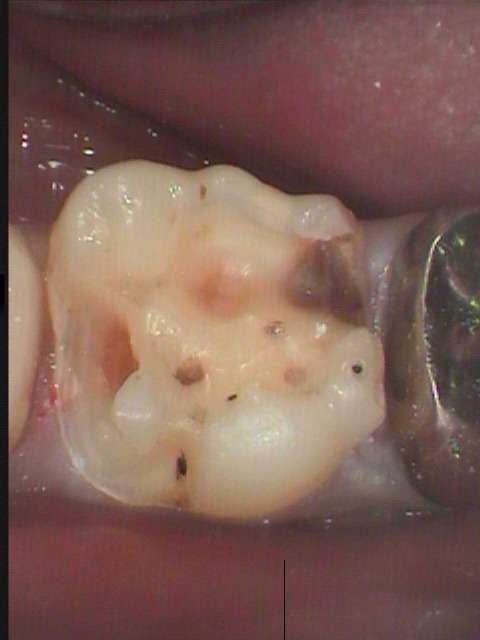 歯間ブラシによる清掃が足りなかったので隣の歯との間に虫歯が発生しました。