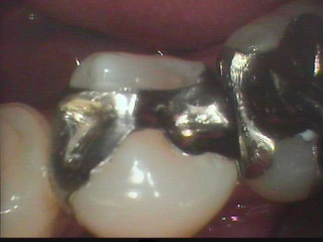 金属が詰めてあった歯が凍みました。金属の内部で虫歯が再発したようです。金属は虫歯の再発に繋がるし、外から見て綺麗なものではありません。
