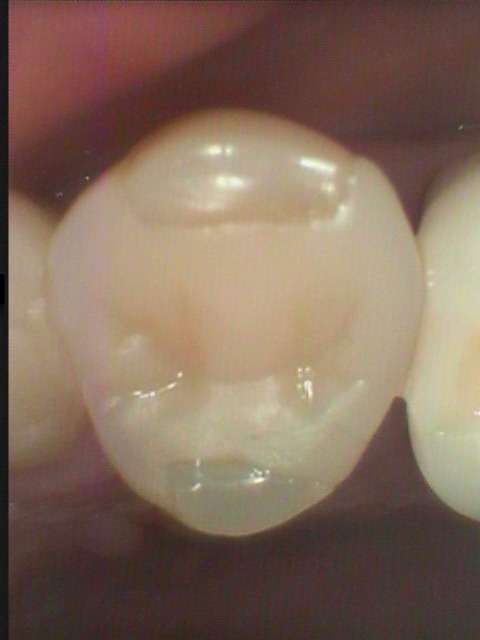 小臼歯の虫歯治療の症例です。当院の虫歯は審美歯科治療で修復し、しかも通院回数は一回です。