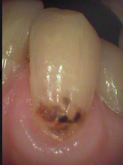 虫歯治療の単純な症例です。成城の鈴木歯科医院では小さな虫歯から大きな虫歯まで全て審美治療で対応しています。