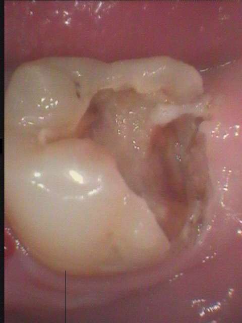 根管治療の症例です。虫歯の進行が大きいので歯の深部に在る神経（歯髄組織）にまで細菌感染しました。綺麗に治療出来ました。