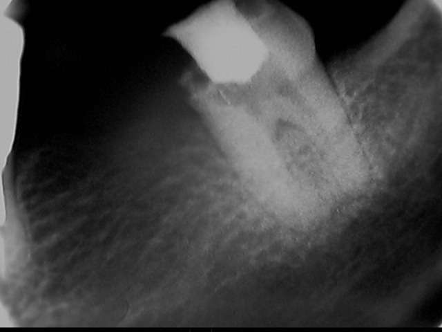 感染根管治療の症例です。下顎の大臼歯に虫歯の細菌が歯髄腔（神経）が感染したので感染根管治療をしました。