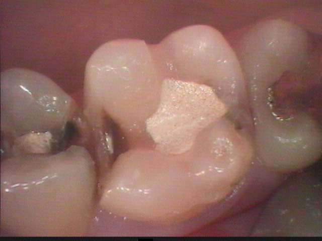 深く進んだ虫歯の治療をしました。将来神経を取らなくても良いようにフッ素徐放性が強いセメントで裏層しました。