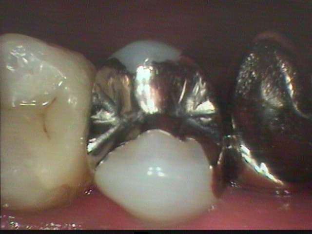 虫歯治療に金属インレー等を詰めるとかなりの確率で虫歯が再発します。金属充填をした所が痛み始め、虫歯が再発したので精密・緊密な接着充填をしました。虫歯再発予防になります。