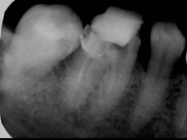 右下と左下の大臼歯を根管治療しました。今回はその術前・術後の2症例です。