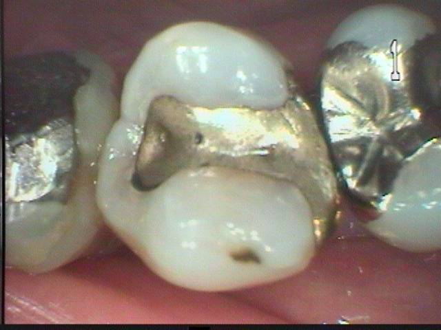 上顎小臼歯を虫歯治療されていますが、金属インレーの下で虫歯がまた再発していました。