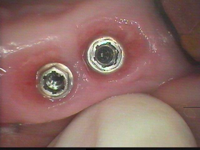 １４年前の症例です。前の歯が６本の入れ歯を入れていましたが、患者様はインプラントを希望して来院されました。その定期検診を毎年2回継続していますが、問題なく噛めています。