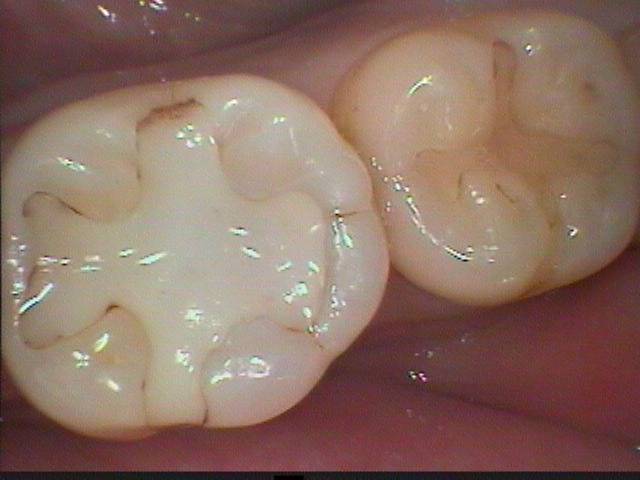 古い詰め物の交換を希望されて来院されましたので、一度に二本の歯を綺麗に治療しました。