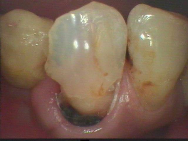 大きな虫歯でしたが、差し歯でなく、その場で充填する治療法で治りました。
