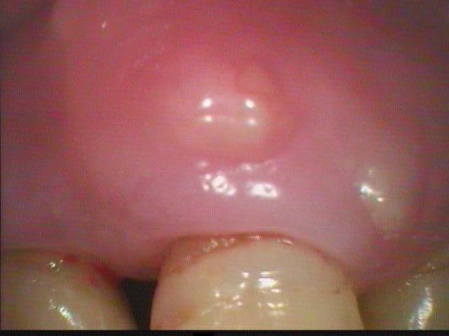 前歯部と臼歯部、感染根管治療の2症例です。