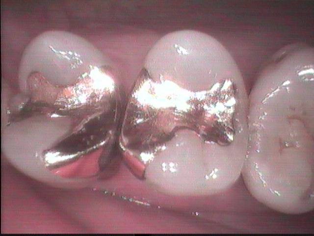 虫歯治療で歯に接着する素材を使うのは、歯を長持ちさせる為です。銀歯だと歯に接着しないので、歯の寿命が長持ちしません。