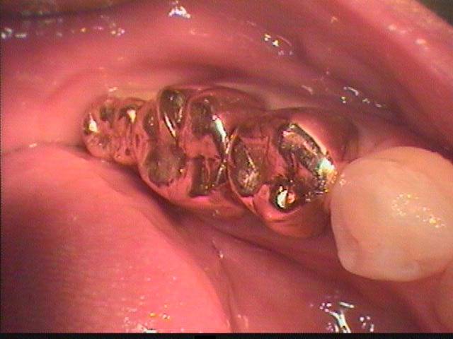ブリッジ支台を支える第一大臼歯の根管が細菌感染していました。その感染根管治療をした症例です。