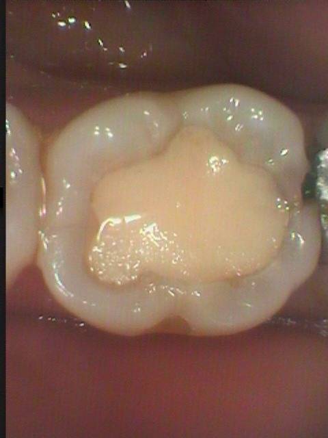 下顎大臼歯の審美的虫歯治療の症例です。虫歯が再発しました。歯間清掃が不足していたようです。