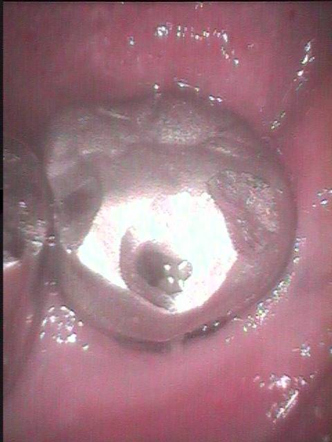 下顎第二大臼歯の根管はしばしば複雑な形状をしています。今回はその感染根管治療の症例です。
