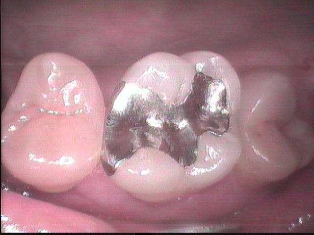 大臼歯の虫歯が深く進行して、もう少しで歯髄組織（神経）に感染する所でした。臼歯の虫歯が深く進行している時は、内部の歯髄組織を保護する為にフッ素徐放性が強い特殊セメントを裏層する必要があります。　　　　