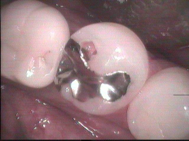 虫歯になったら、歯に接着する詰め物で治療すべきです。金属インレーを詰めている虫歯治療をよく見かけますが、虫歯の再発が起こり易いです。　　　　　　　　　　　　　　　　　　　　　　　　　　　　　　　　　　　　　　　　　　　　　　　　　　　　　　　　　　　　　　　　　　　　　　　　　　　　　　　　　　　　　　　　　　　　　　　　　　　　　　　　　　　　　　　　　　　　　　　　　　　　　　　