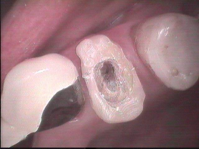 根管治療後は歯が破折しないように、クラウン（冠）を被せました。これを精密に造らないと虫歯再発の原因になります。