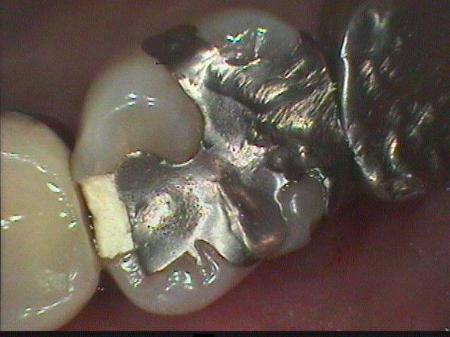 虫歯の進行が深かったので歯髄組織（神経）が露出しました。しかし神経を取らないで済むようにしました。