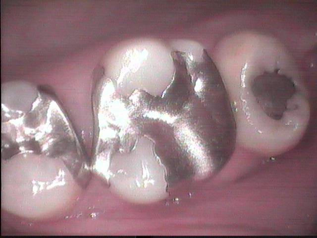 虫歯の再治療の症例です。金属を詰めると端から細菌が侵入して虫歯が再発する恐れがあります。