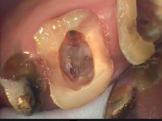 大臼歯には3本から4本の細長い根管（神経）が在るので、その感染を治す根管治療は困難です。今回はこれをを一度に2本行いました。