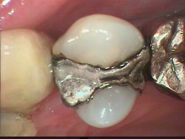 古い虫歯治療を現代風に治しました。今は虫歯再発が少ない治療法が在ります。