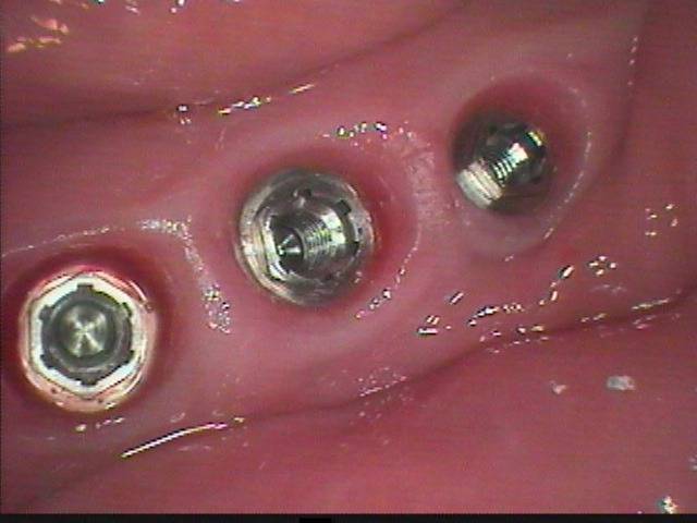 暫く入れ歯で噛んでいましたが、３本のインプラントに変えたので、劇的に安定し症例です。